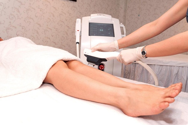 Công nghệ triệt lông Diode Laser